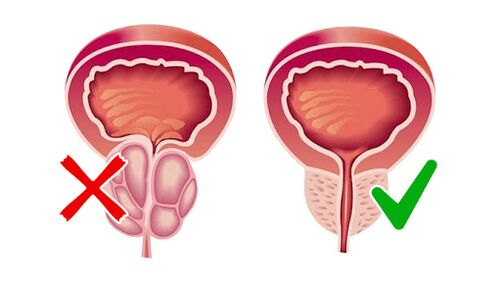 Prostata vor und nach der Anwendung von Prostaline
