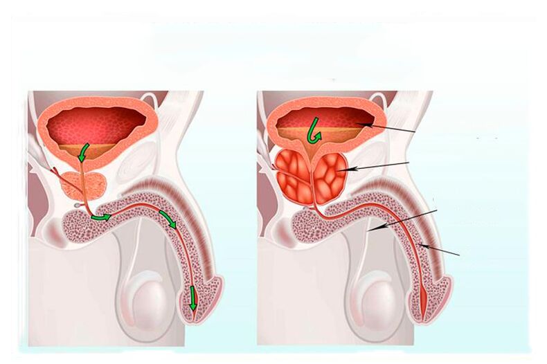 Norm und Entzündung der Prostata