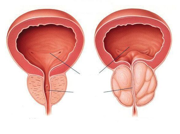 normale Entzündung der Prostata und Prostata